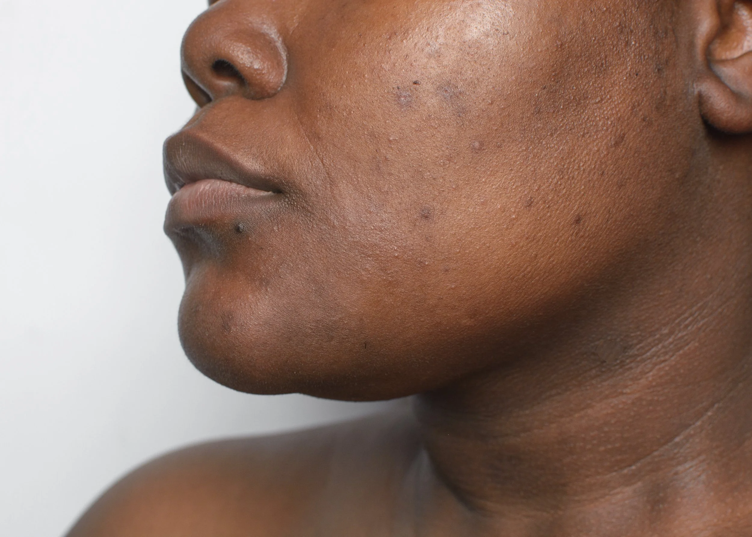 Why Your Dark Spots Keep Coming Back: Understanding Tyrosinase &amp; Pigment Correction
