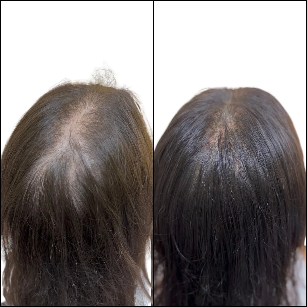 Case study (Full mid scalp and Full crown):

This client was experiencing alopecia and was on minoxidil for several years now. She hasn&rsquo;t seen a great change in minoxidil and wanted to look for something to boost her confidence. She found out a