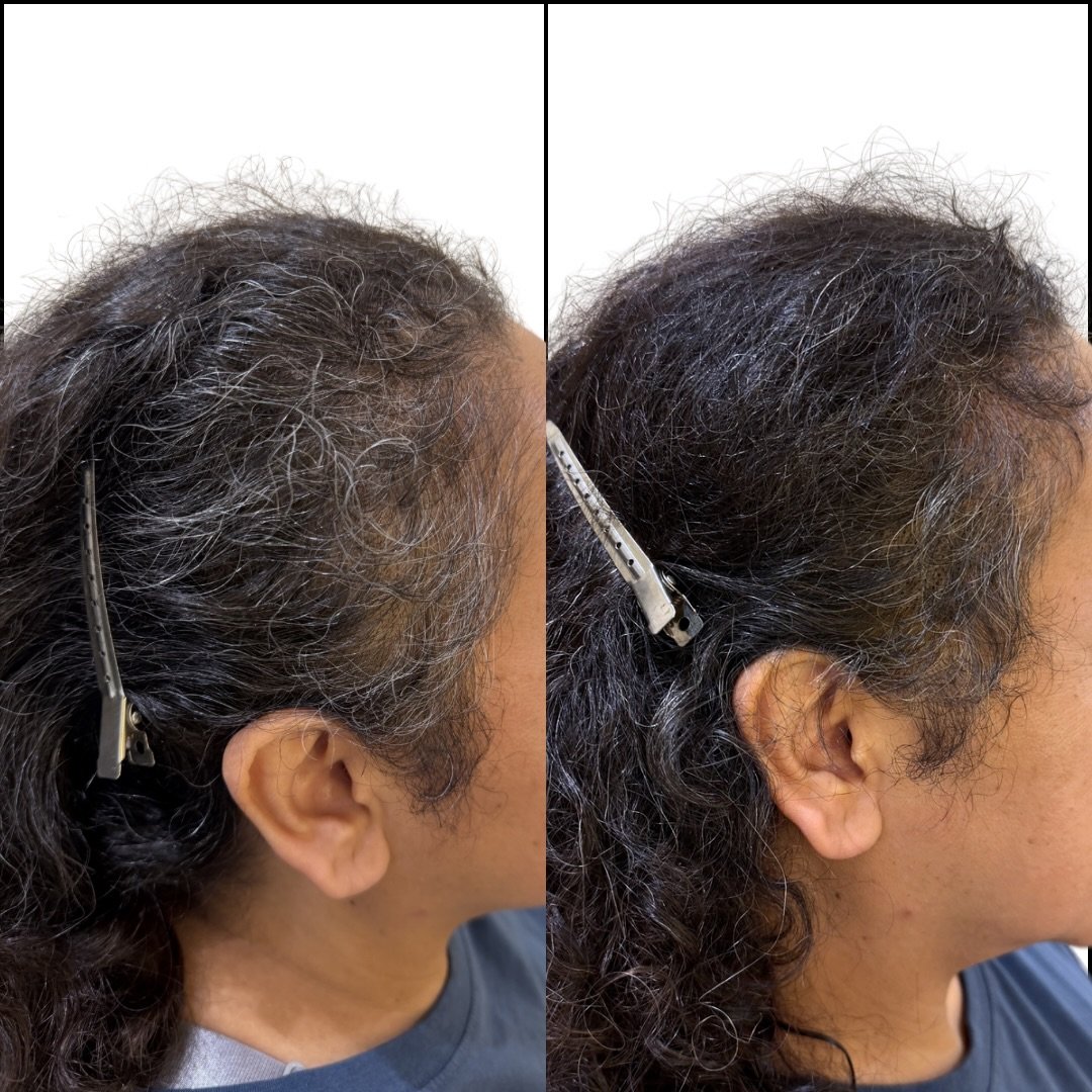 Before and After of Hairline and Sideburn area treatment (first session): 
 
This client had started experiencing menopause and started thinning on the sides and hairline. She wanted to look for options that weren&rsquo;t permanent in case she wanted