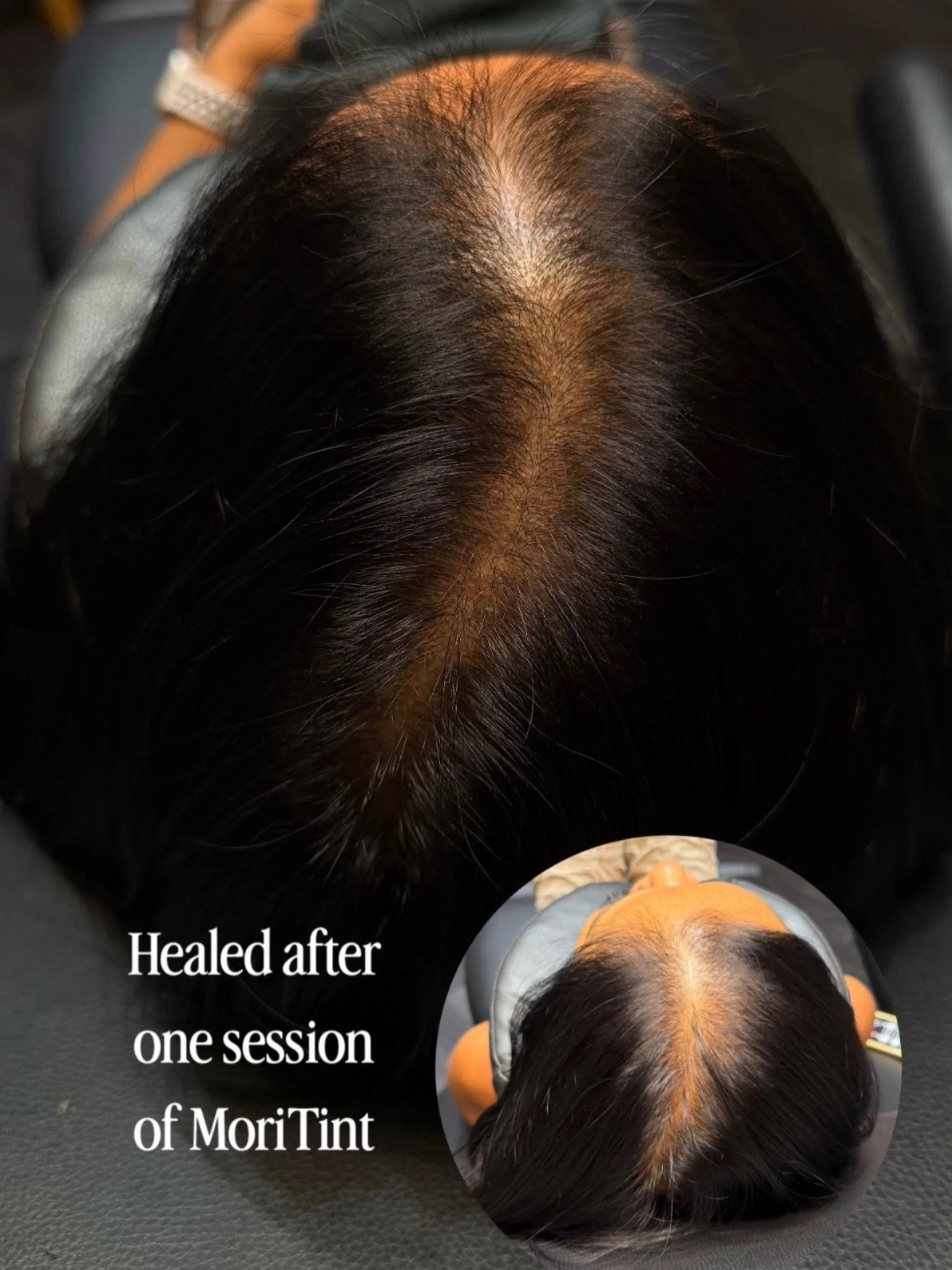 Look at this healing 👀 Full crown and midscalp coming through beautifully after session one, and we&rsquo;re already building during the touch-up phase.

Here&rsquo;s what made the difference: This client showed up prepared. Hydrated, thoroughly exf