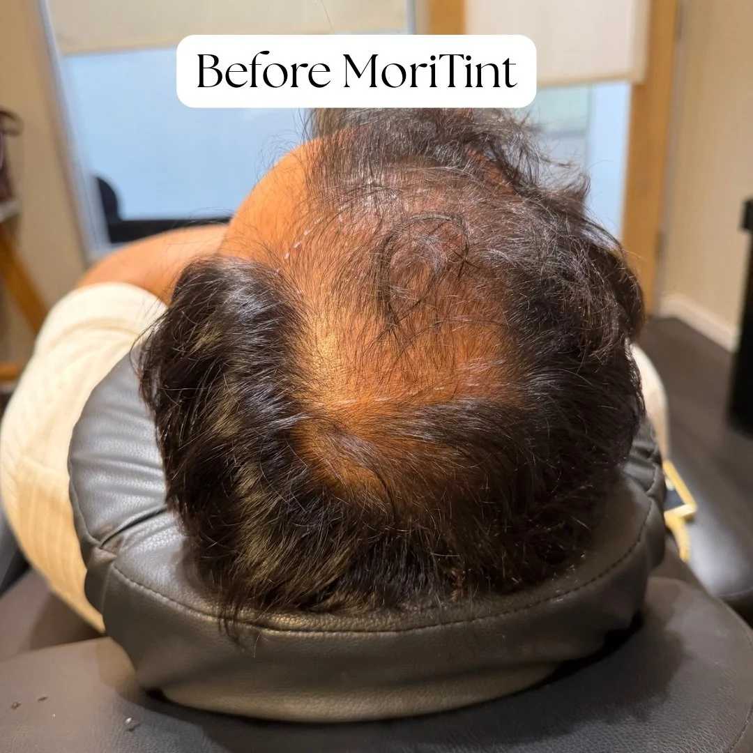 All photos shown are unedited and as honest as it gets. This carousel will give you a good idea of what the process of MoriTint can look like. 

He got amazing retention! It healed so softly and delicately. It just appears that he has more density th
