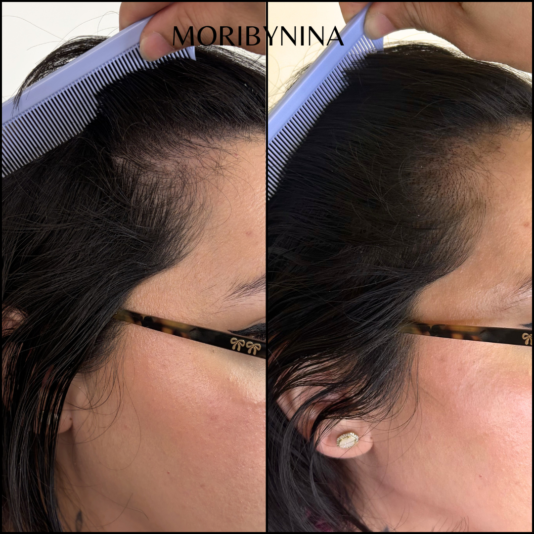 Close-up side view of a woman with dark hair, showing hair thinning at the hairline on the left and improved hair density on the right, with a hand holding a blue comb. Woman is experiencing female hair loss and hair thinning at the hairline.