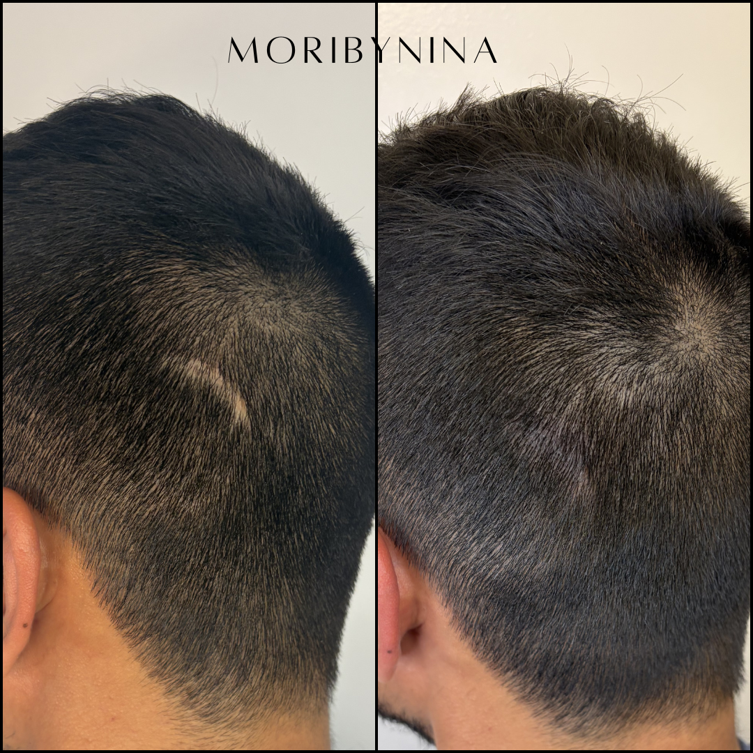 Before and after picture of a man with a small thin scar that has no hair with treatment with Moritint/ scalp micropigmentation. Undetectable and natural results.