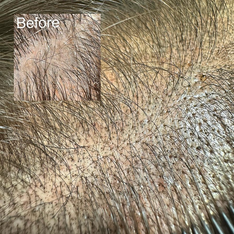Before and after pictures of scalp micropigmentation. Korean Moritint as the dots are placed on the epidermis layer of the skin and appears natural and undetectable.