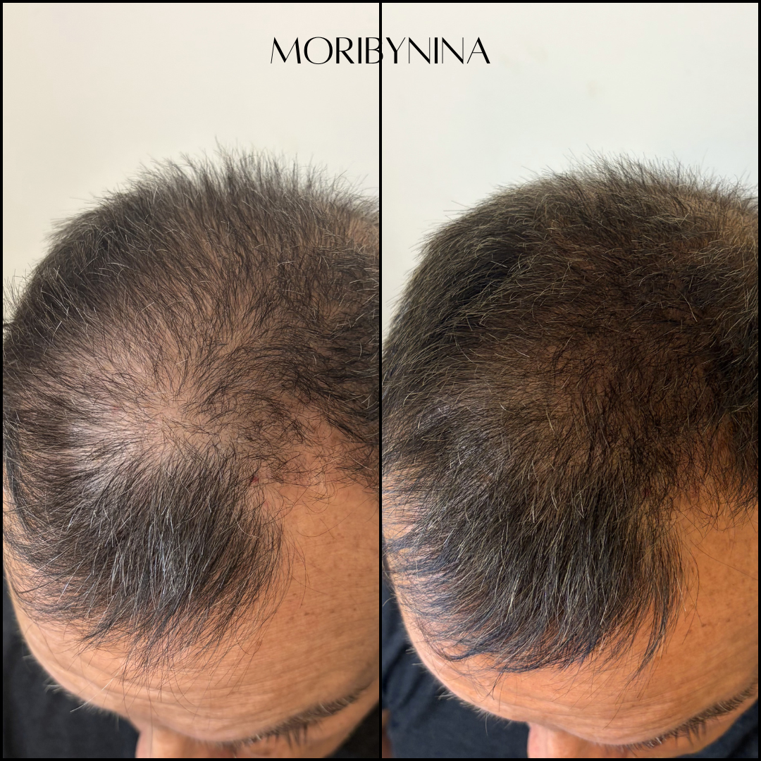 Before and after images showing undetectable art in hair density on the top of a man's head after korean scalp micropigmentation. Man has androgenetic alopecia