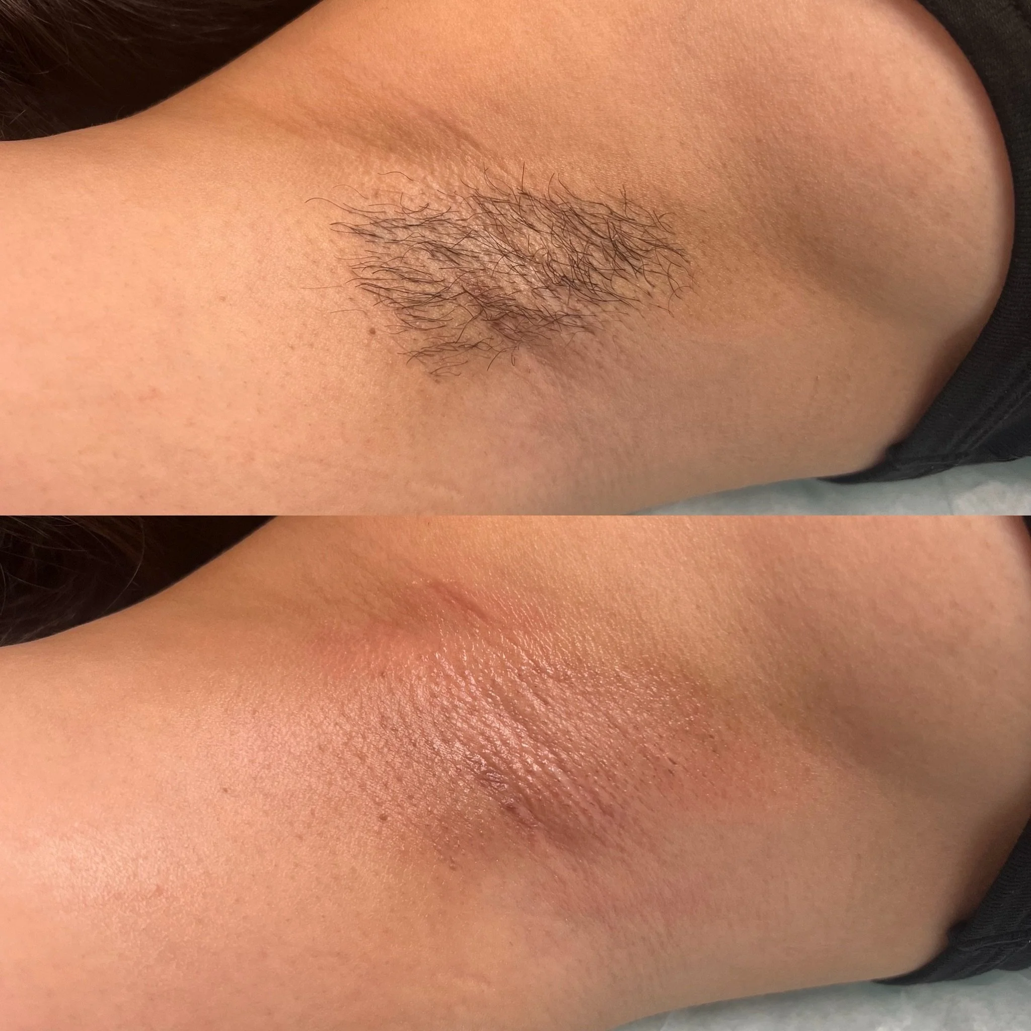 UNDERARM WAX BEFORE &amp; AFTER 🍯 

One of the quickest waxing services with some of the best results 👏🏼

If you&rsquo;re tired of:
🚫 Shaving every few days
🚫 Razor burn
🚫 Dark shadows under the arms
🚫 Stubble showing up the next day
🚫 Ingrow