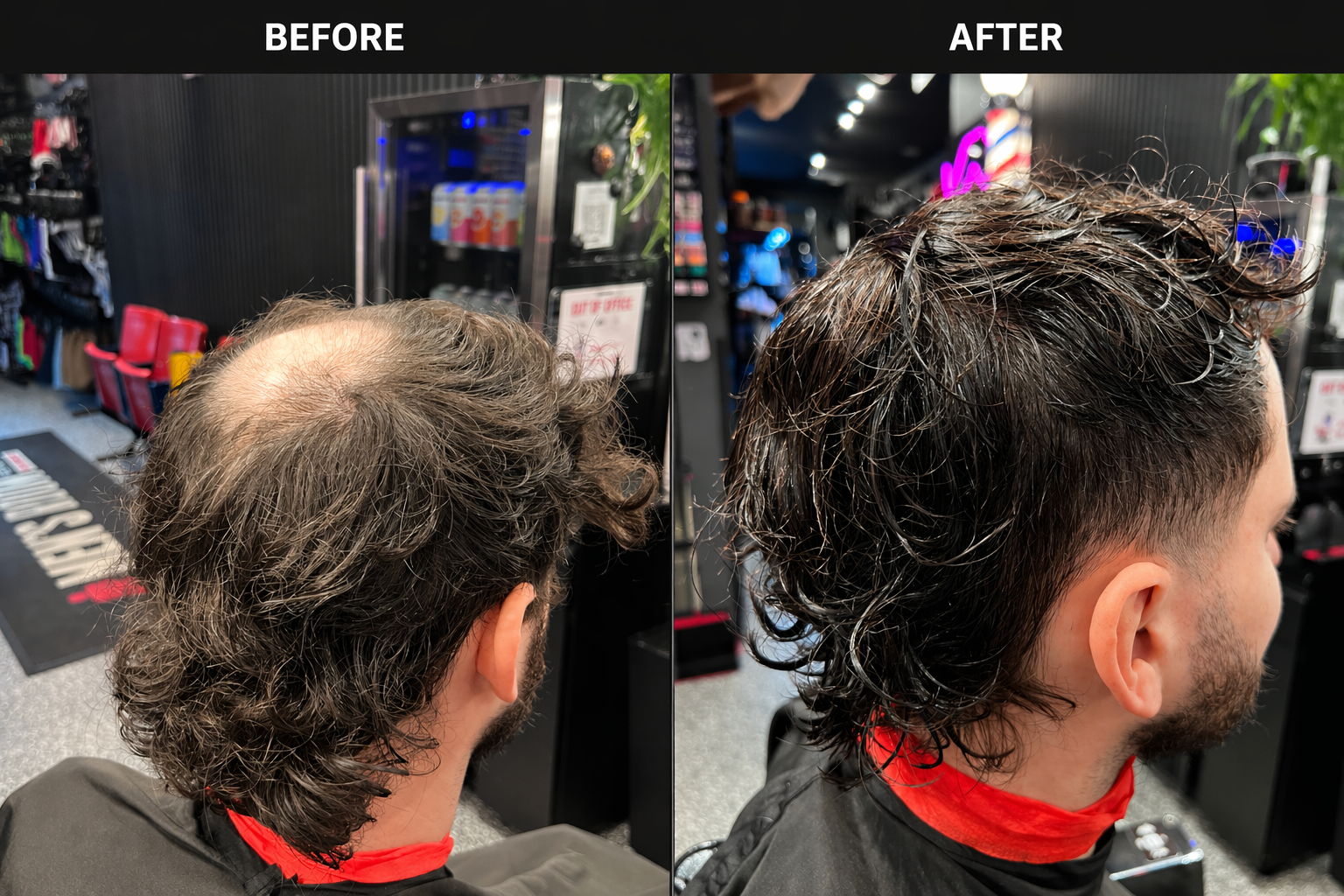 Men's Hair System at the crown