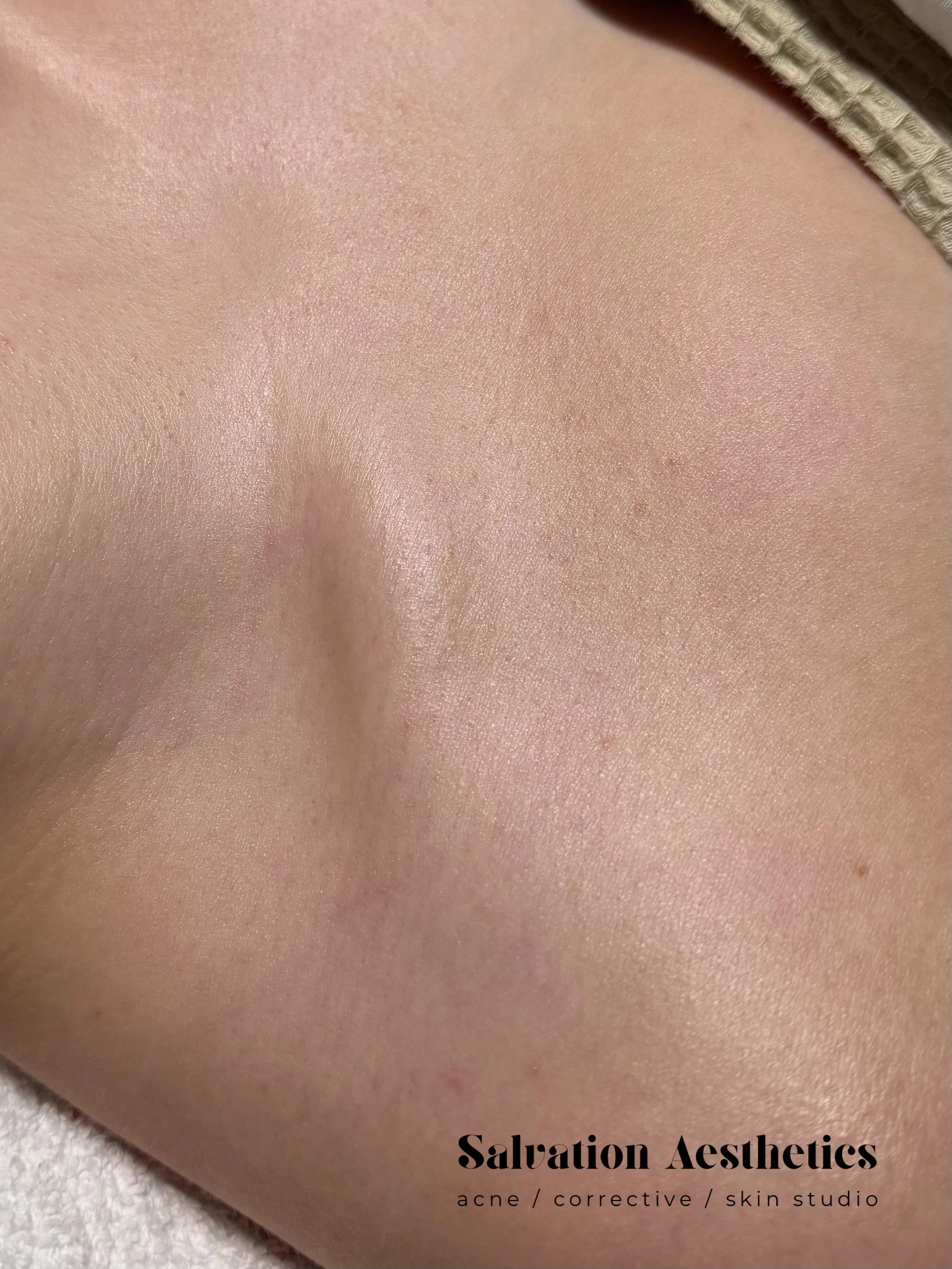 Derm Stumped by ACNE IMPOSTER 🧐

This client visited a dermatologist for a sudden onset of bumps on her chest. She never had acne on her body before maybe the occasional little bump on her face during her menstrual cycle (side note: I always refer o