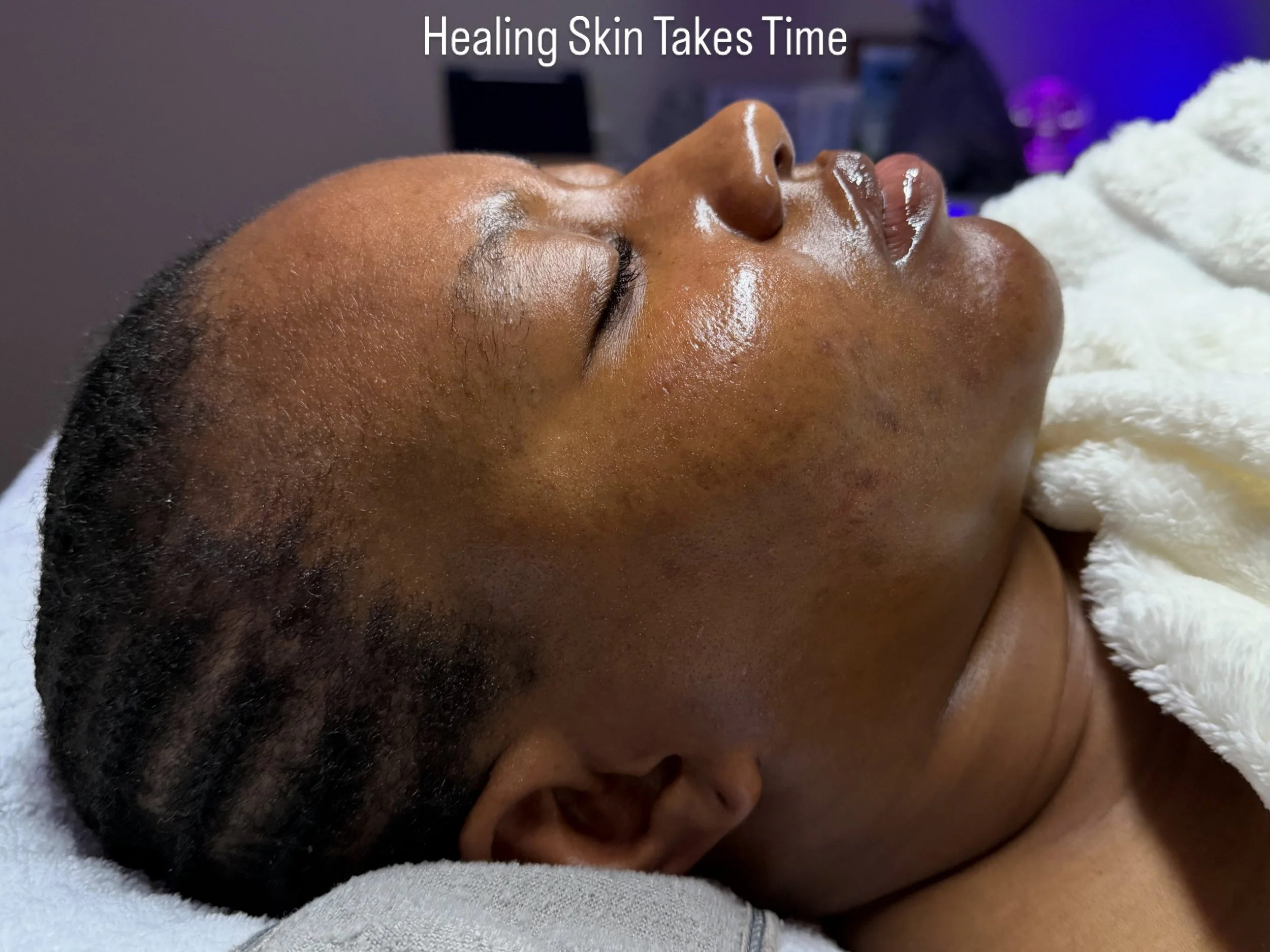 When you focus on repairing the barrier , calming the inflammation , clearing the congestion , keeping the skin hydrated and balanced you can make progress 

When you see your skin daily it&rsquo;s hard to recognize the differences 🤍

Salvation Aest