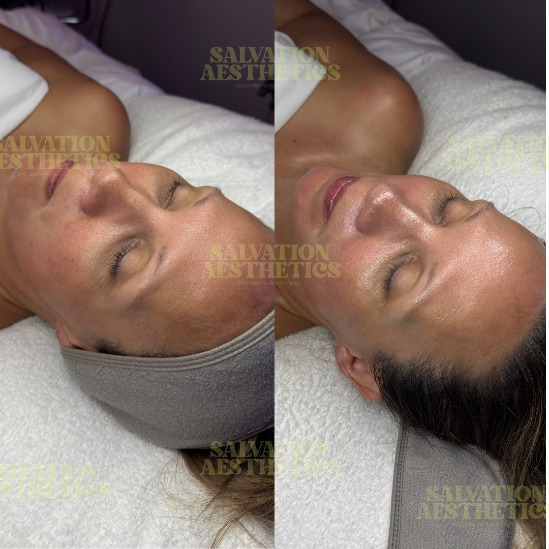 Before and After Corrective Facial