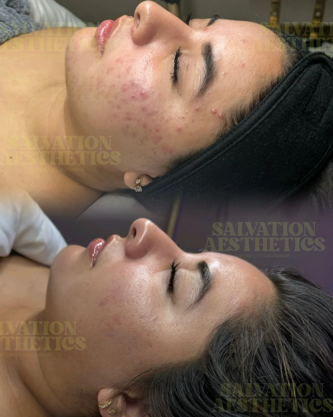 Before and After of Acne Prone skin