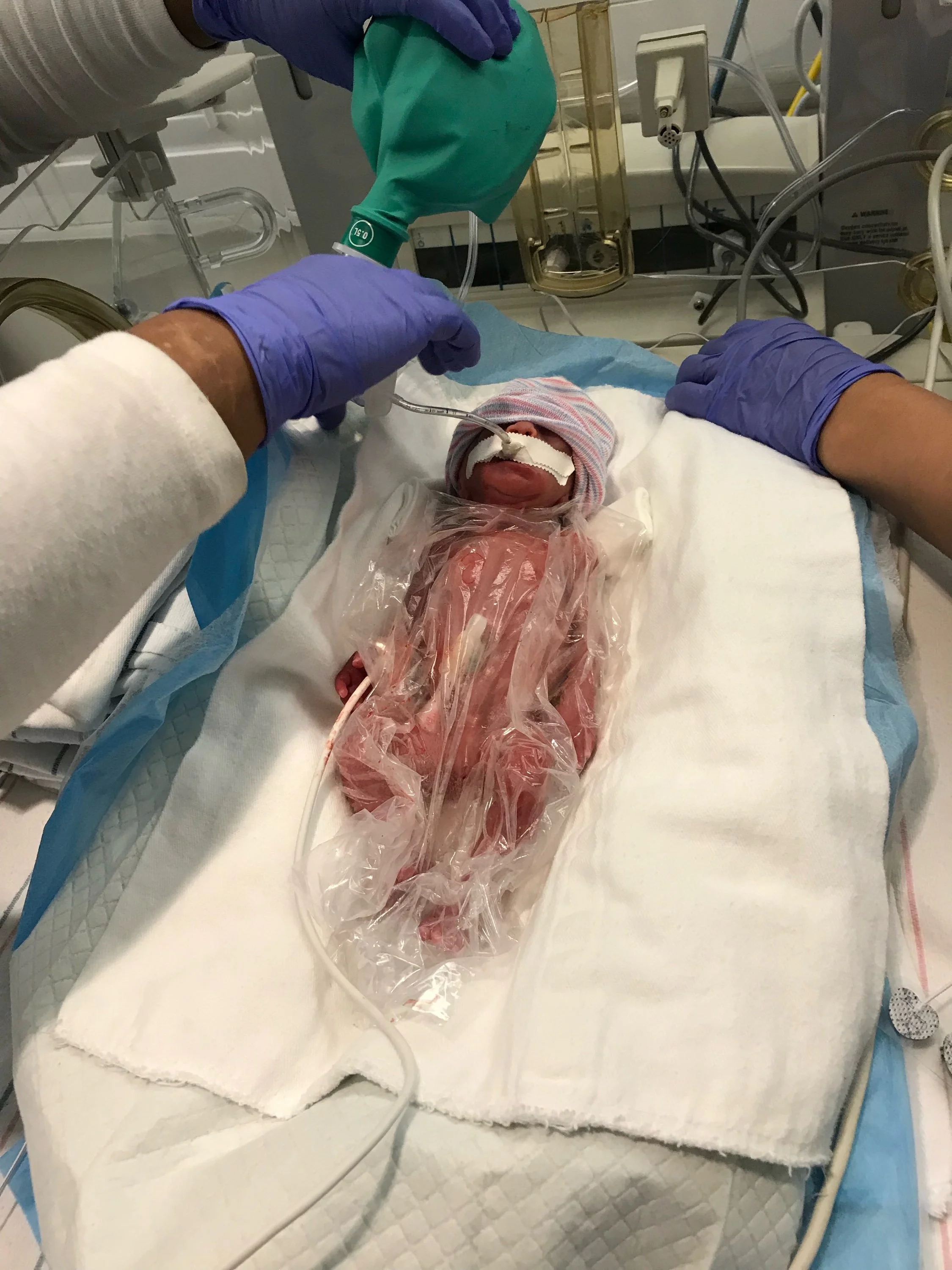 25-week infant immediately after delivery, placed in a bag for warmth due to being intubated.