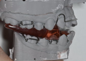 Patient guide for Twin Block appliance