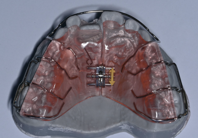 Patient guide for removable appliances