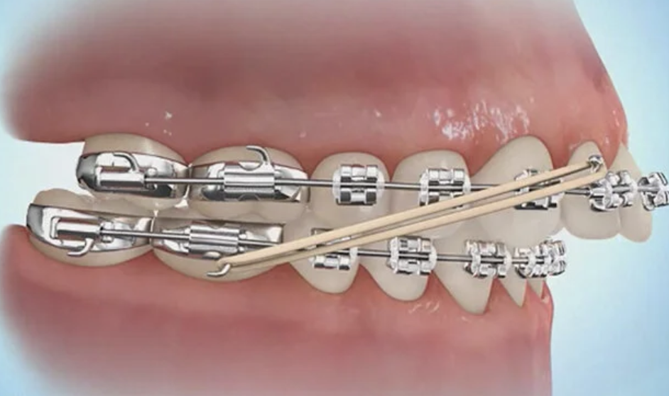 How to wear orthodontic elastics