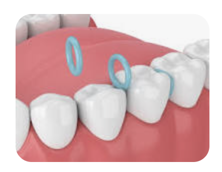 Your guide to orthodontic separators
