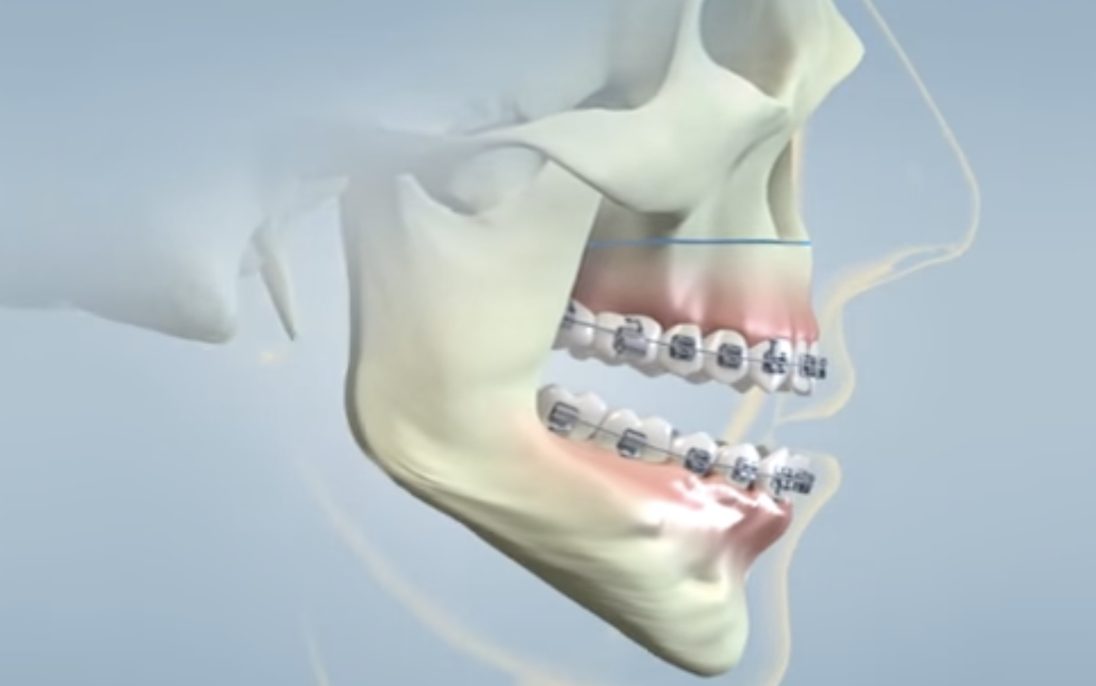 What is jaw surgery?
