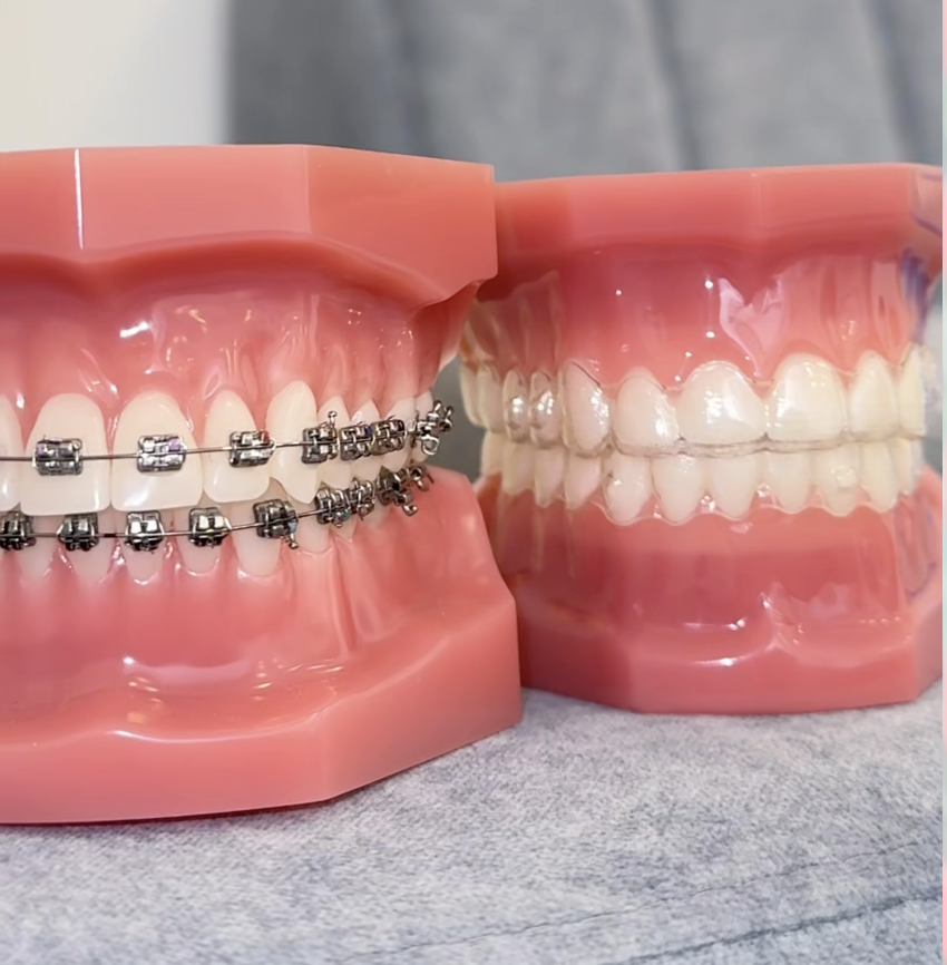 Braces vs. Aligners&nbsp; — Which One Is Right for You?