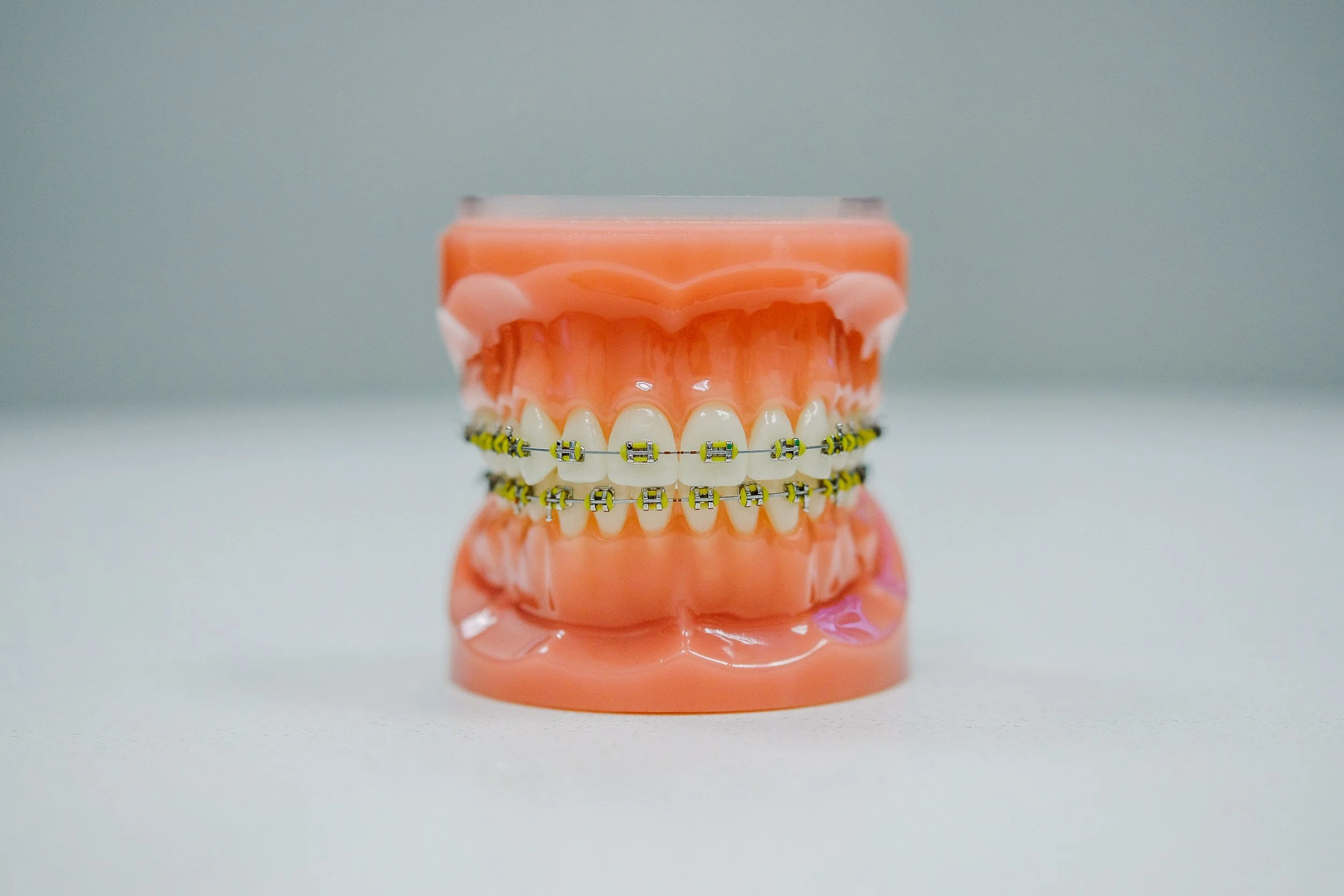 Braces in Singapore: Cost, Pain, Best Age to Start &amp; Everything Else You're Probably Googling at 1am