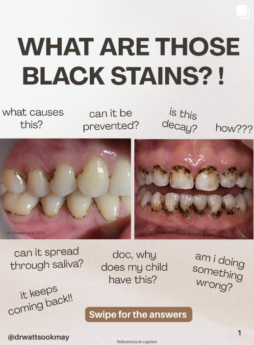 🛑 BLACK STAINS ON YOUR TEETH? Before you panic…
