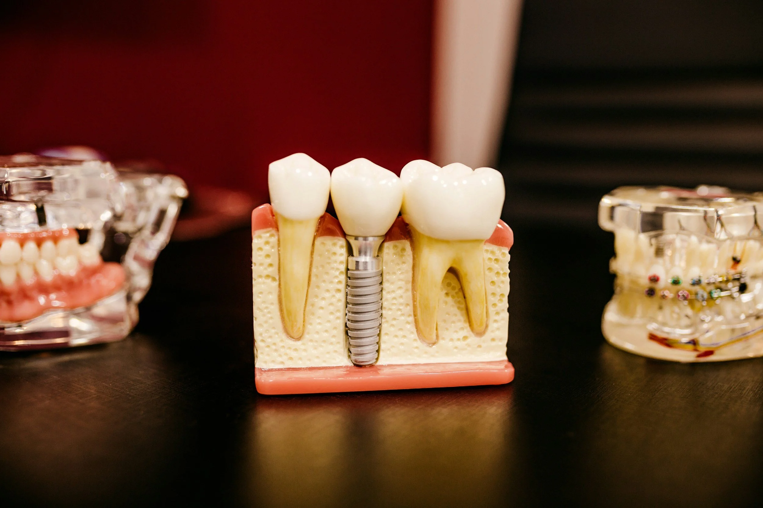 A dental model displaying a dental implant with a crown, alongside models of teeth with braces and other dental appliances.