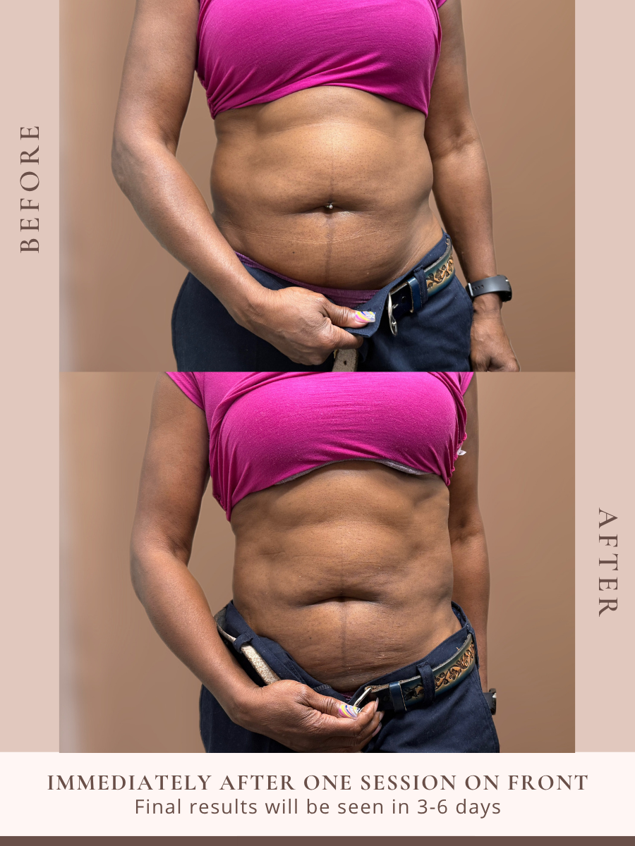 Non-invasive body sculpting treatment at Beauty X Ross in Pooler Georgia