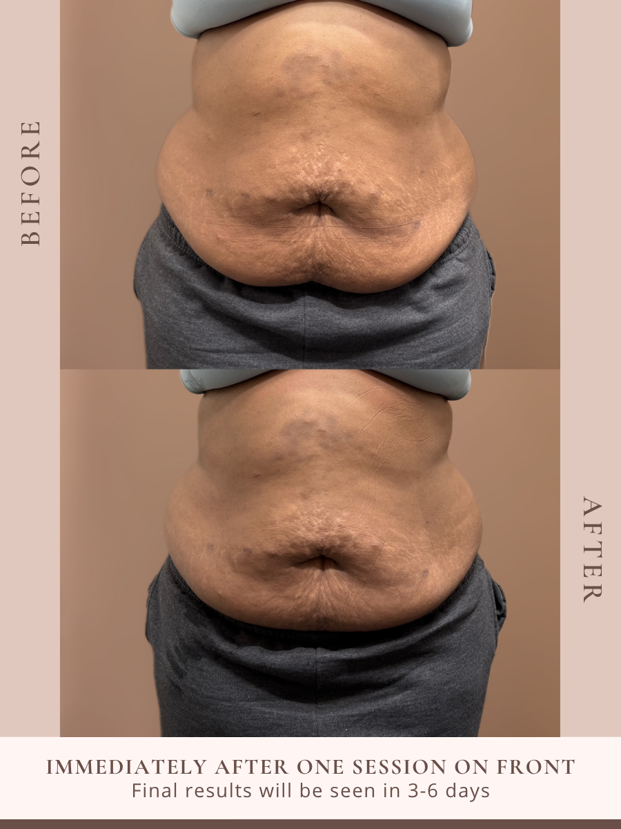 Non-invasive body sculpting treatment at Beauty By Ross in Pooler Georgia