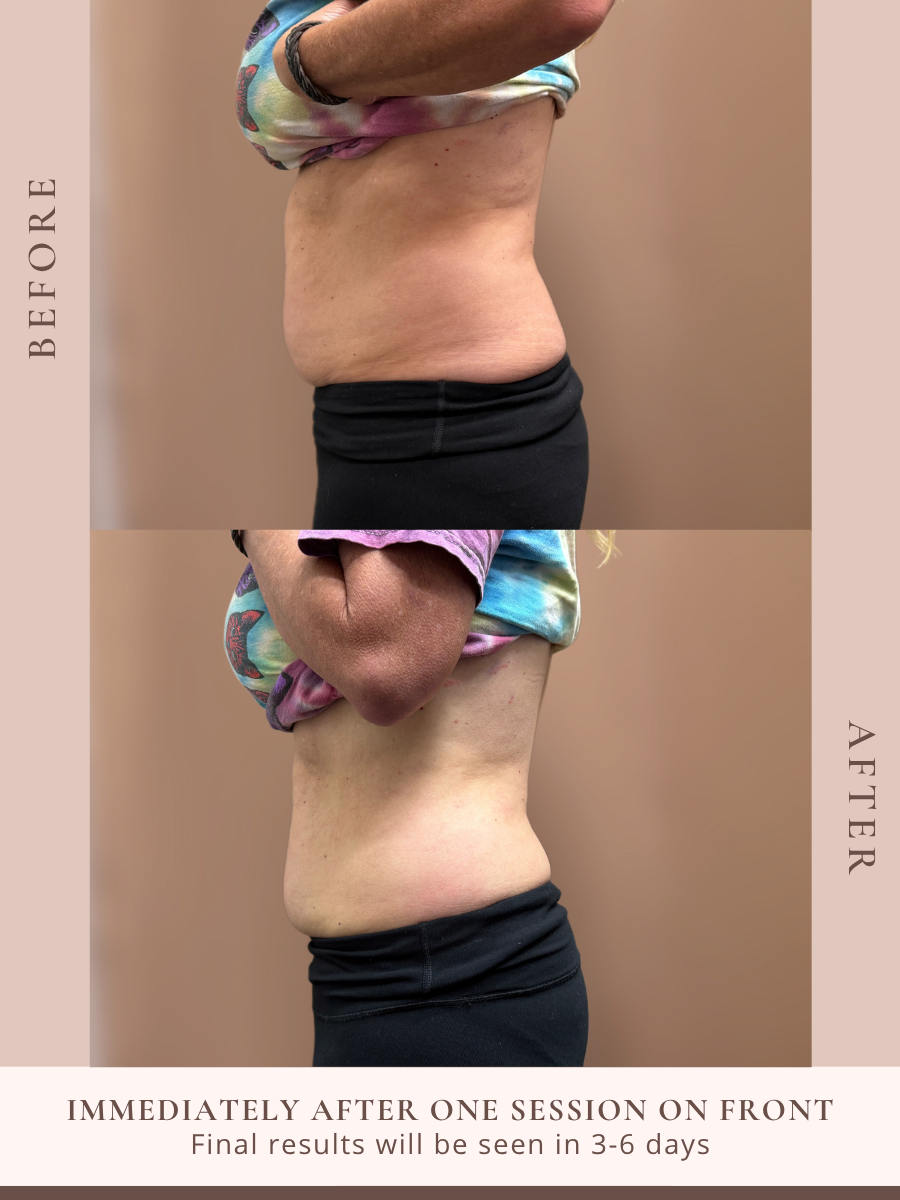 Non-invasive body sculpting treatment at Beauty X Ross in Pooler Georgia