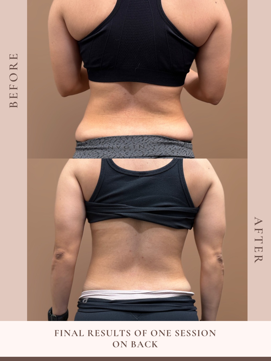 Non-invasive body sculpting treatment at Beauty By Ross in Pooler Georgia
