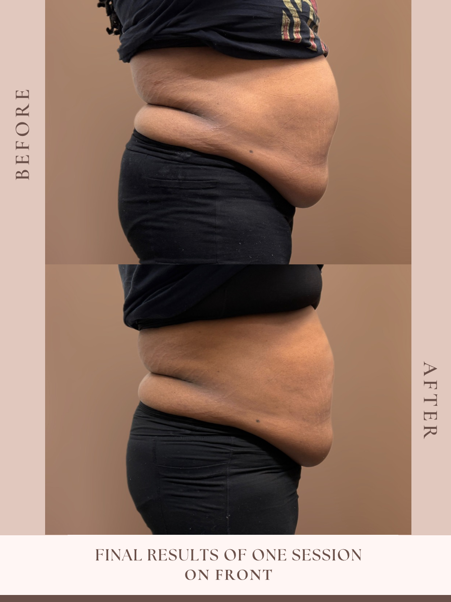 Non-invasive body sculpting treatment at Beauty By Ross in Pooler Georgia