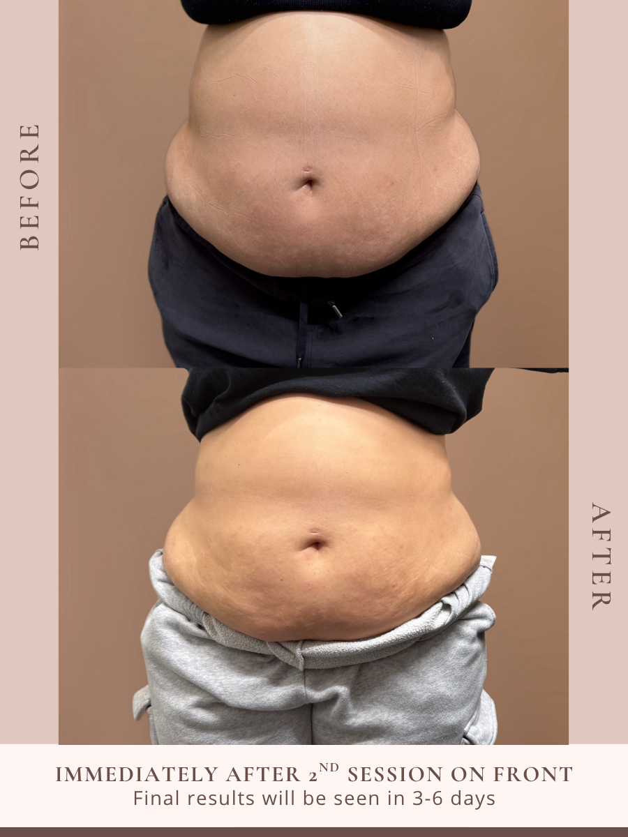 Non-invasive body sculpting treatment at Beauty X Ross in Pooler Georgia
