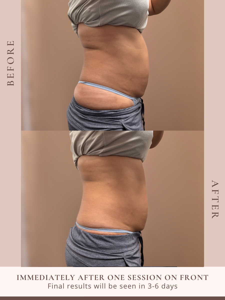 Non-invasive body sculpting treatment at Beauty X Ross in Pooler Georgia