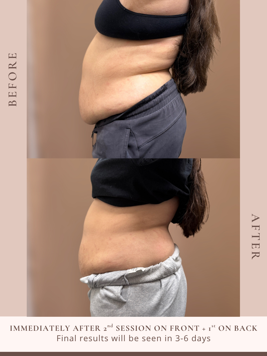 Non-invasive body sculpting treatment at Beauty X Ross in Pooler Georgia