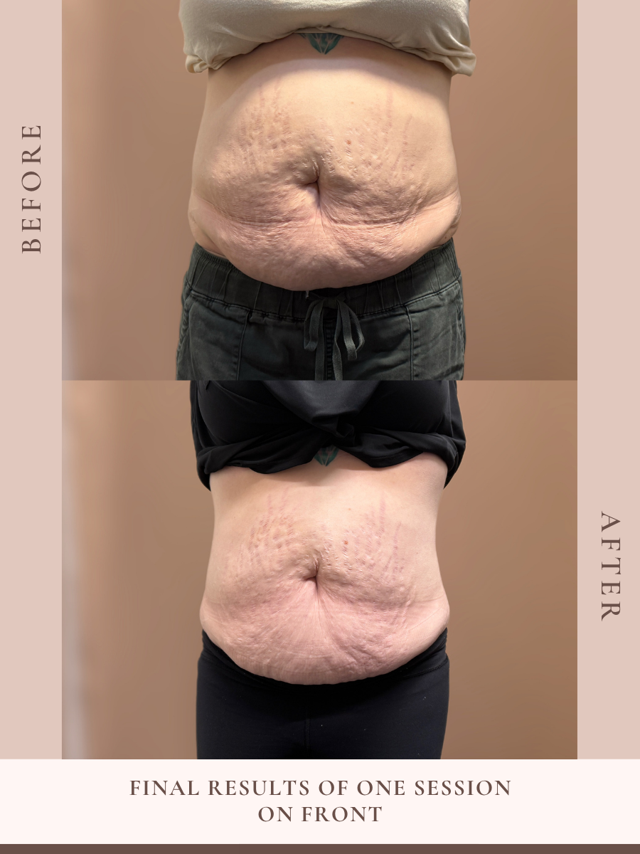 Non-invasive body sculpting treatment at Beauty X Ross in Pooler Georgia