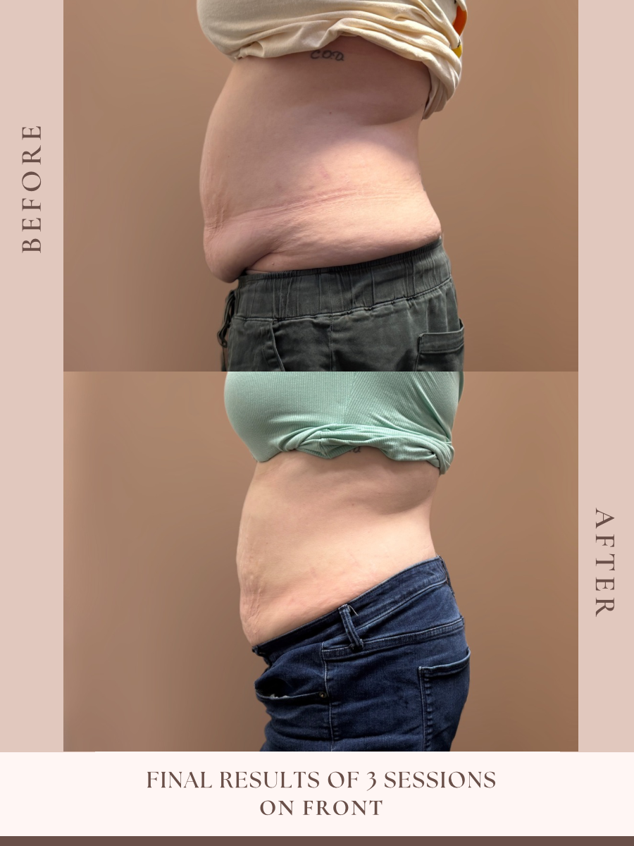 Non-invasive body sculpting treatment at Beauty By Ross in Pooler Georgia