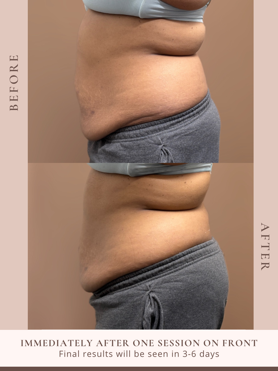 Non-invasive body sculpting treatment at Beauty By Ross in Pooler Georgia