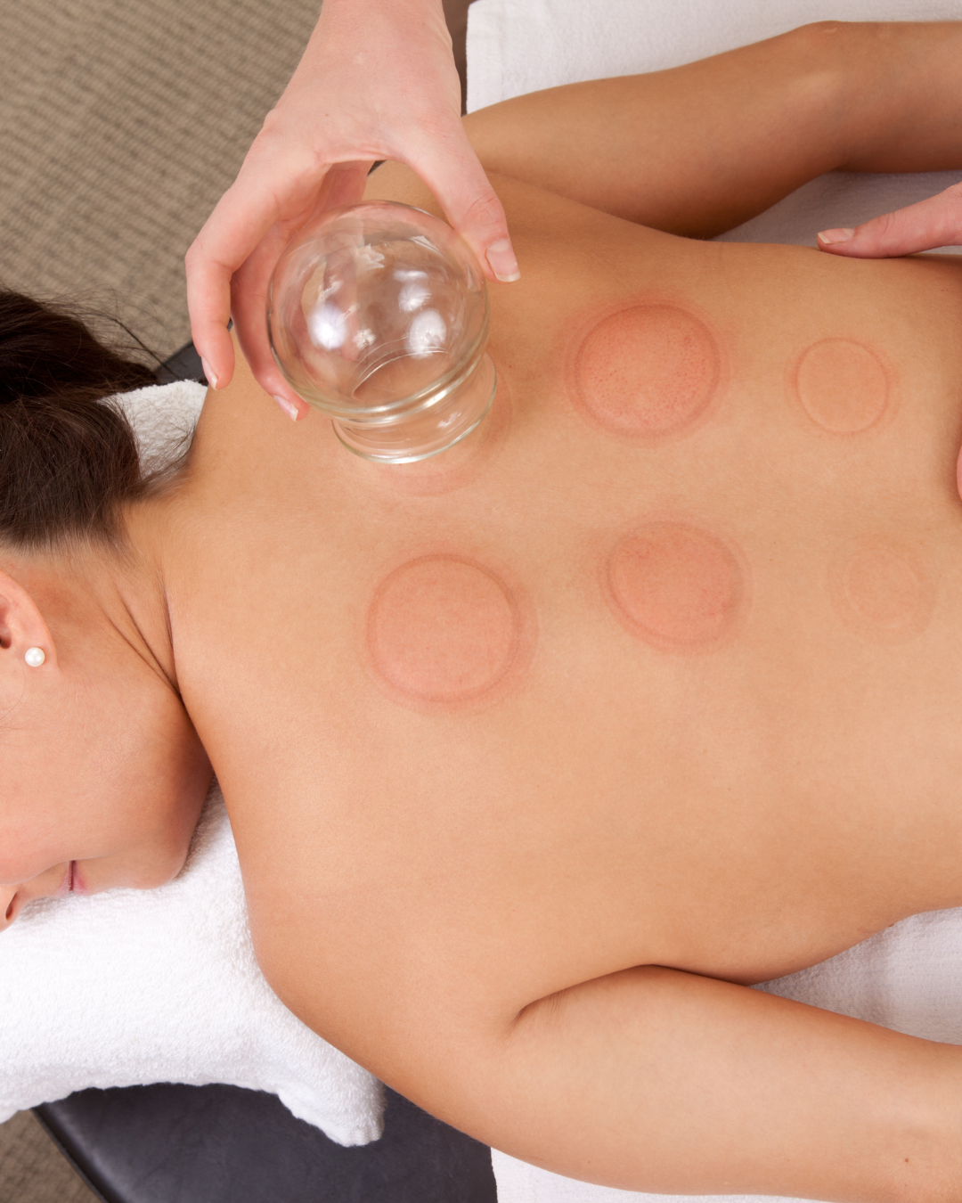 A woman receiving a cupping therapy treatment on her back at a clinic. Multiple glass cups are placed on her back and a practitioner is holding an empty glass cup.