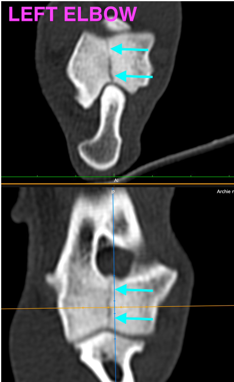 Humeral intracondylar fissure