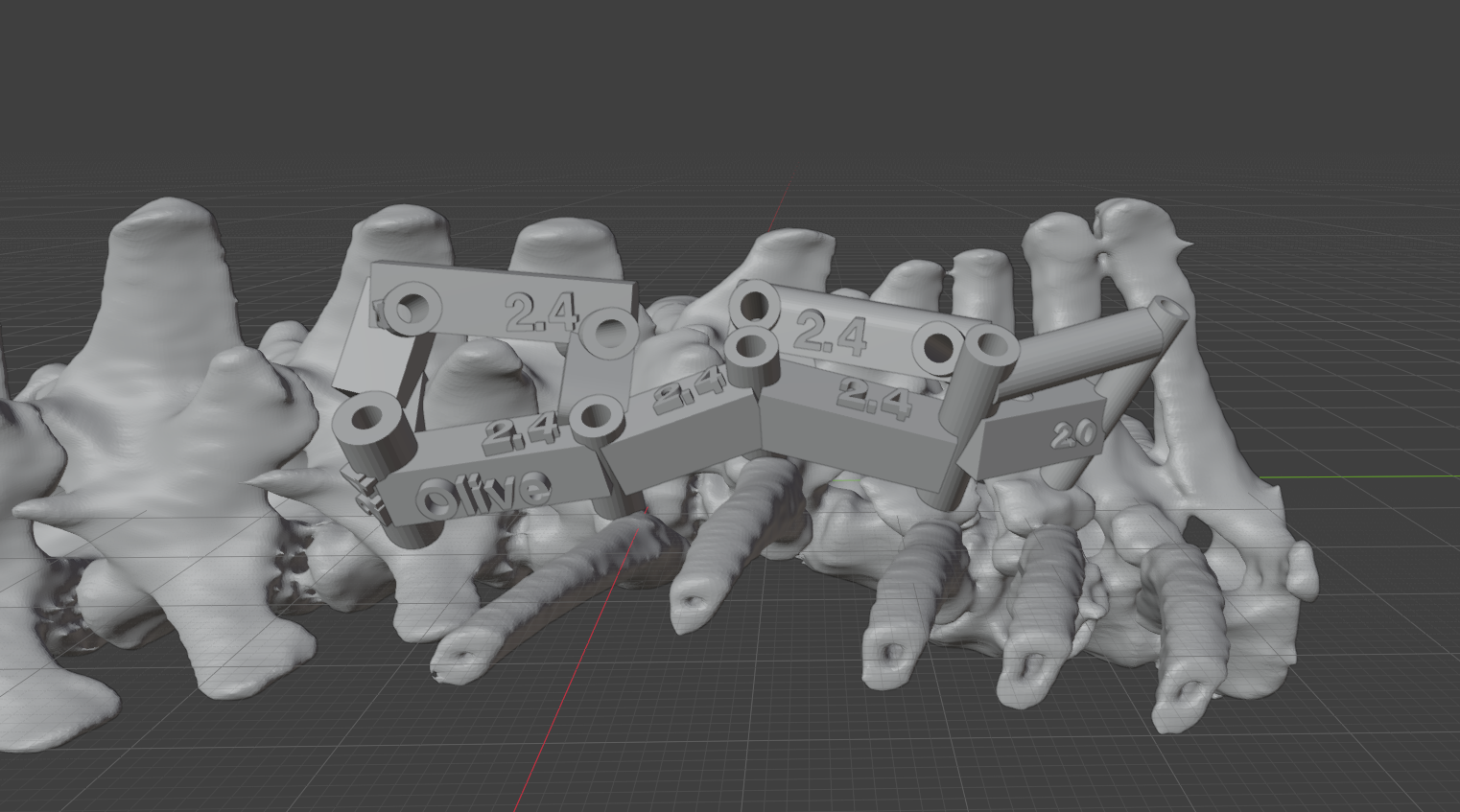 Patient-Specific Spinal Drill Guide