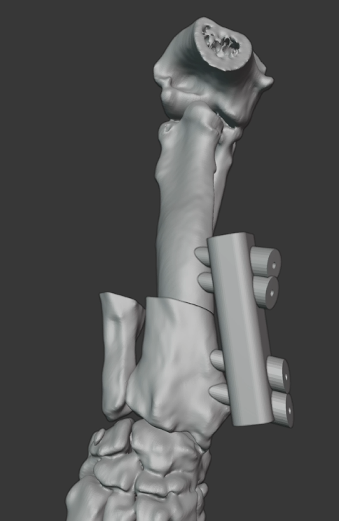 Patient-specific osteotomy and reduction guide package