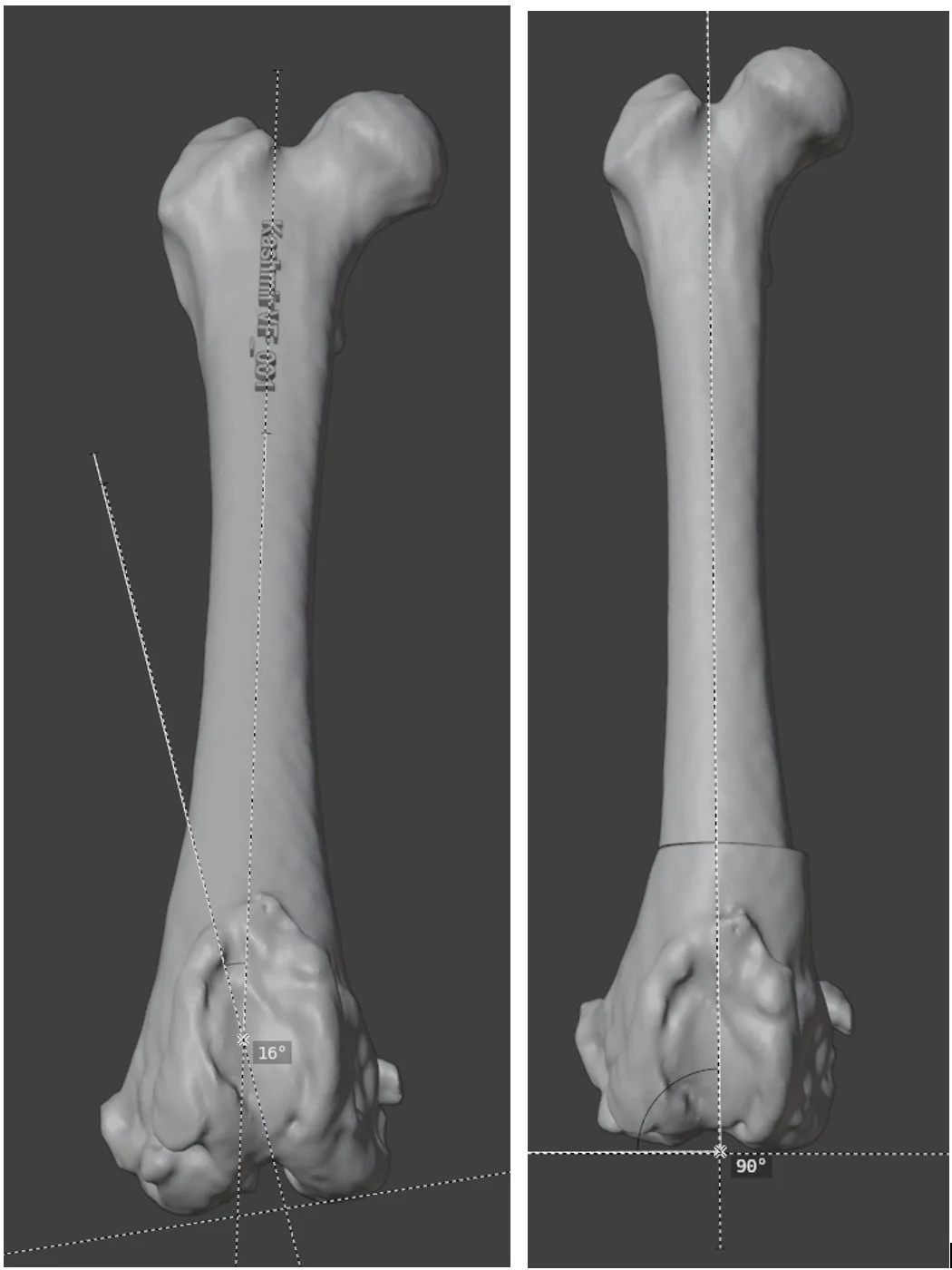 Patient-Specific DFO Guide for Revision Patella Luxation Surgery