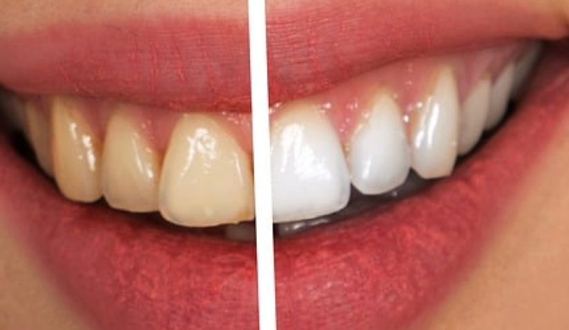 Close-up of a person's smile showing teeth before and after teeth whitening, with the left side showing yellowed teeth and the right side displaying noticeably whiter teeth. Tooth Be Told Business. 