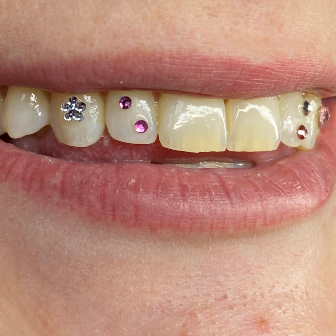 Close-up of a person's mouth with chipped teeth decorated with colorful rhinestones or stickers.