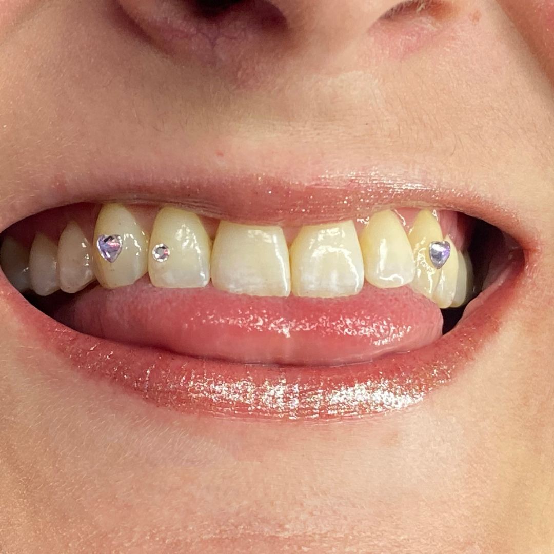 Close-up of a person's smiling mouth with yellow teeth decorated with small purple heart-shaped and round rhinestones.