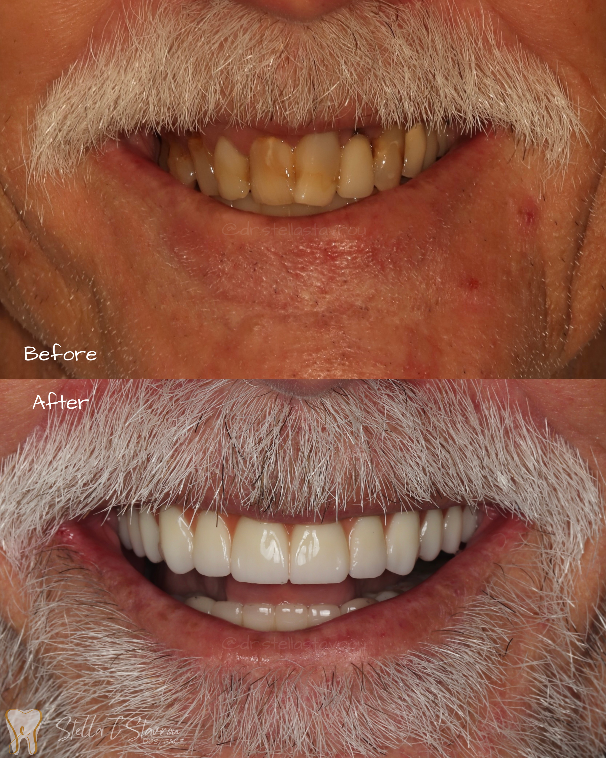 Full mouth implant (All-on-X) rehabilitation