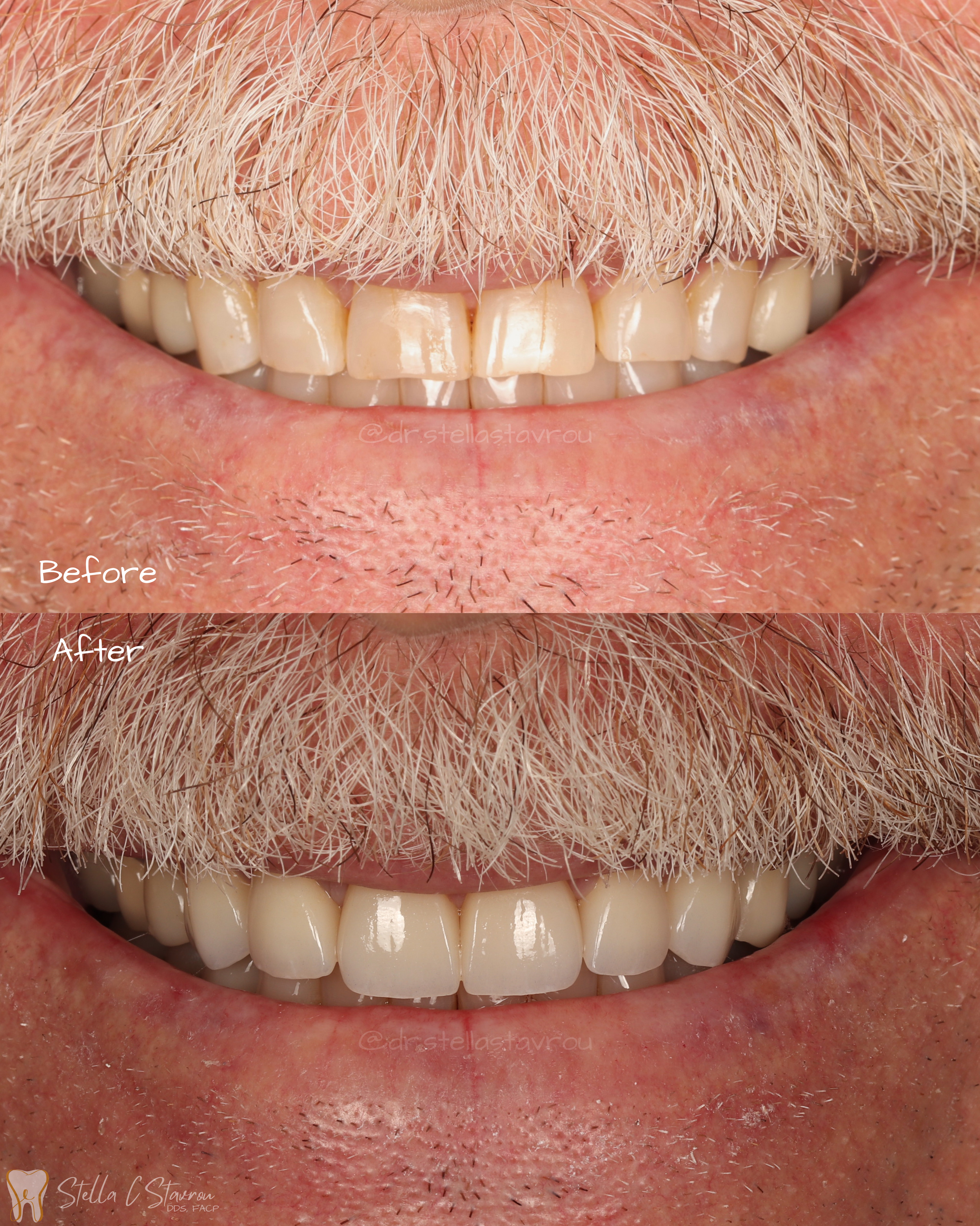 Cosmetic rehabilitation with anterior crowns