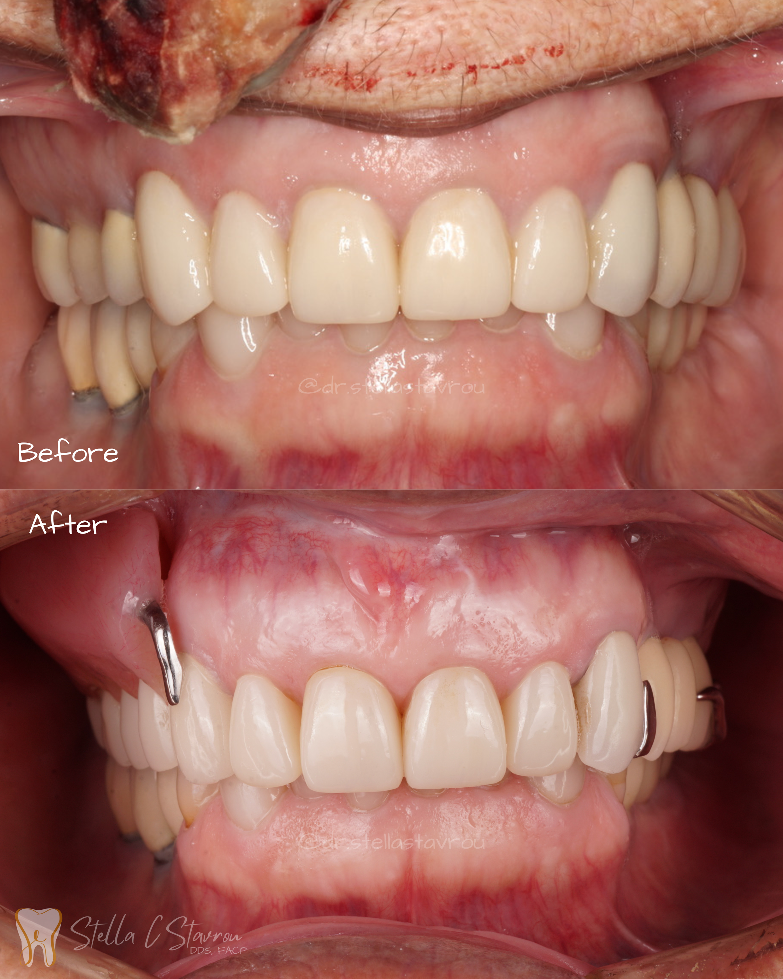 Maxillofacial obturator partial denture prosthesis