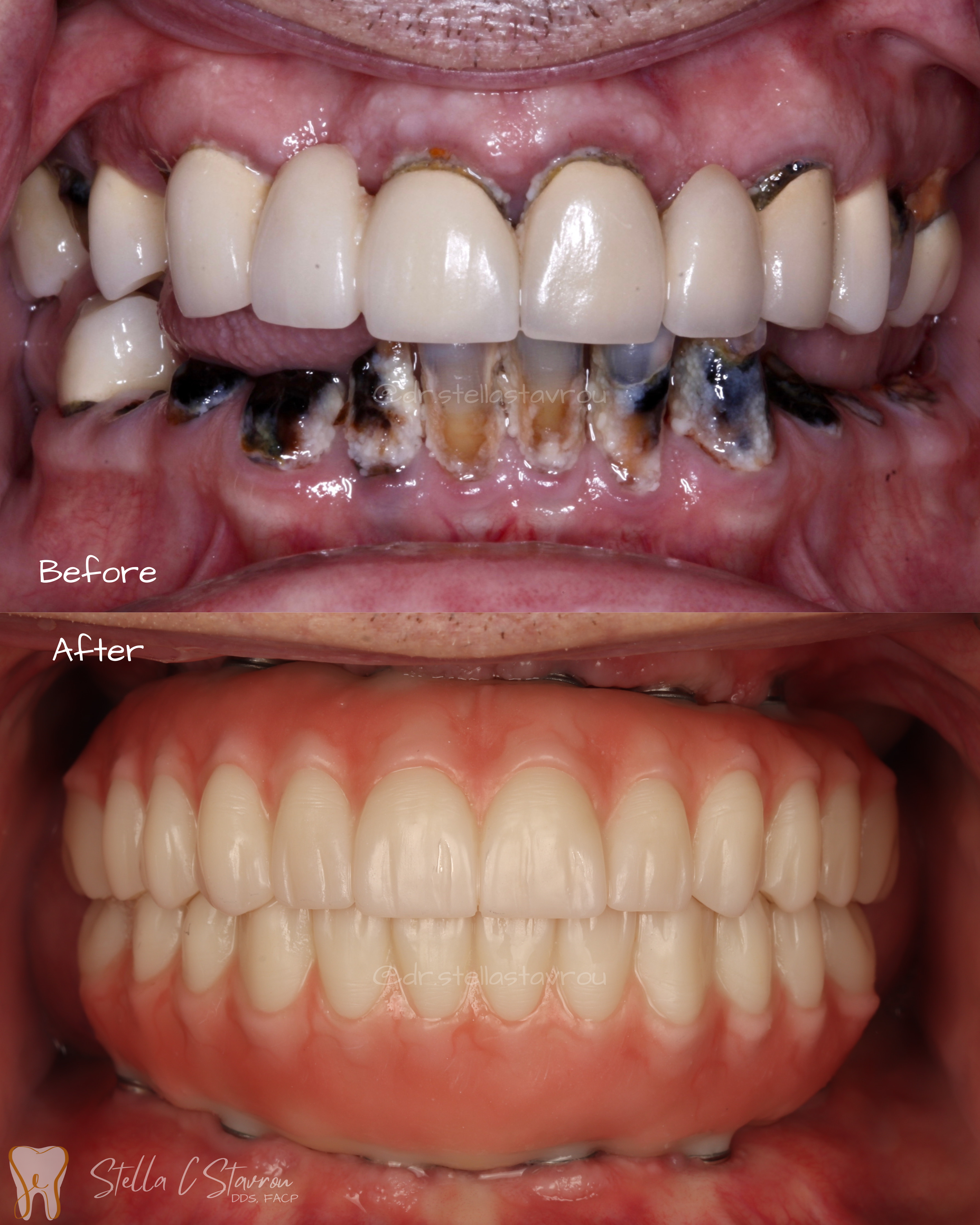 All-on-X implant rehabilitation