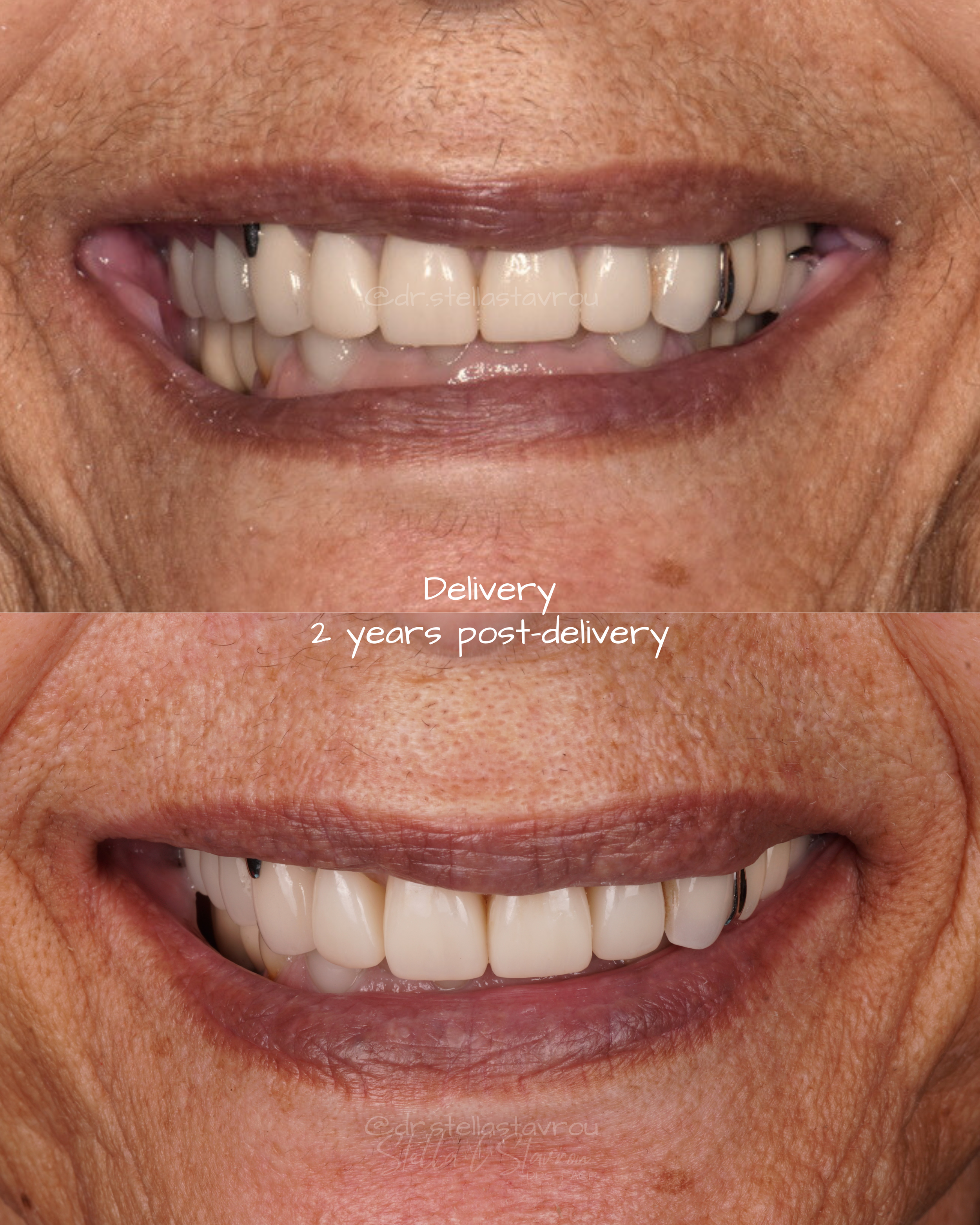 Maxillofacial obturator partial denture prosthesis