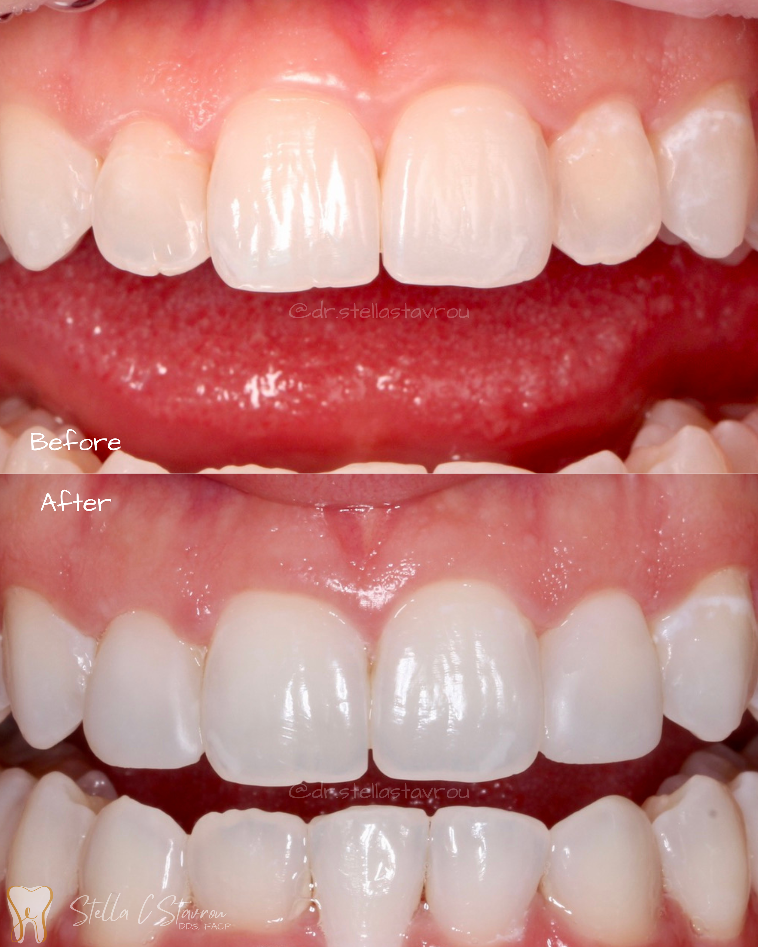 Composite bonding